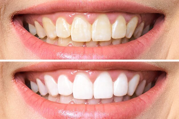 dentes-antes-e-depois-do-clareamento_168410-587.jpg