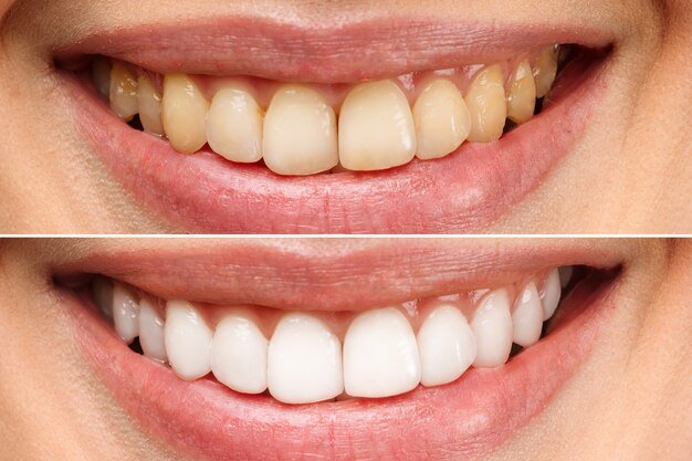 dentes-da-mulher-antes-e-depois-do-clareamento-sobre-fundo-branco_168410-1693.jpg